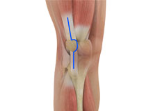 Muscle Sparing Total Knee Replacement