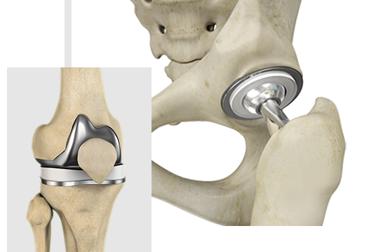 Joint Replacement Specialist
