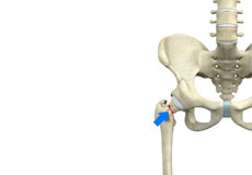 Femoral Neck Fracture