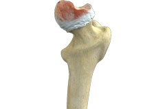 Hip Osteonecrosis