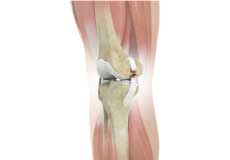 Knee Ligament Injuries