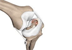 Meniscal Tears