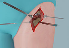 Muscle Sparing Anterior Hip Replacement