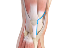 Muscle Sparing Total Knee Replacement