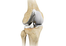 Partial Lateral Knee Replacement