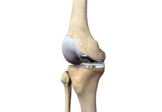 Partial Medial Knee Replacement