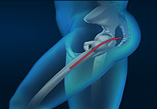 Posterior Hip Replacement