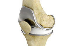 Total Knee Replacement