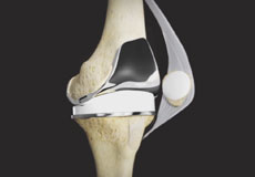 Tricompartmental Knee Replacement