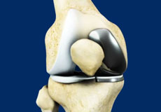 Unicompartmental/Partial Knee Replacement